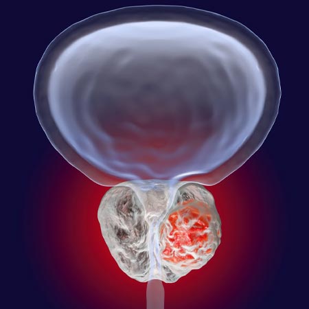 Burning Urine and Blood in Urine Treatment